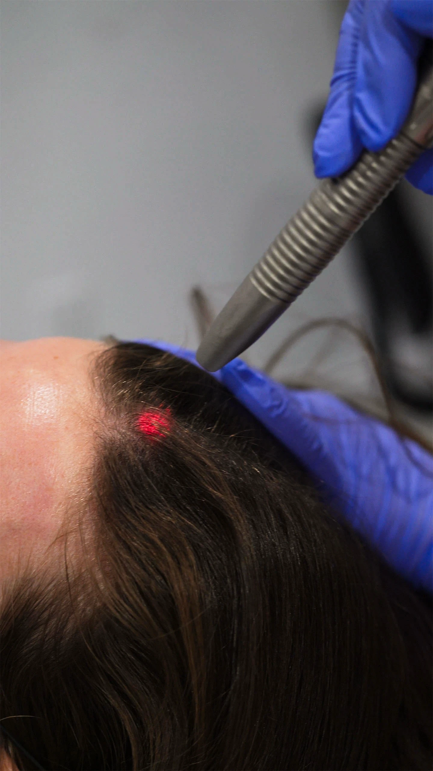 HAIRestart treatment with the Fotona laser on the scalp at Clinique SkinIN to stimulate hair growth.
