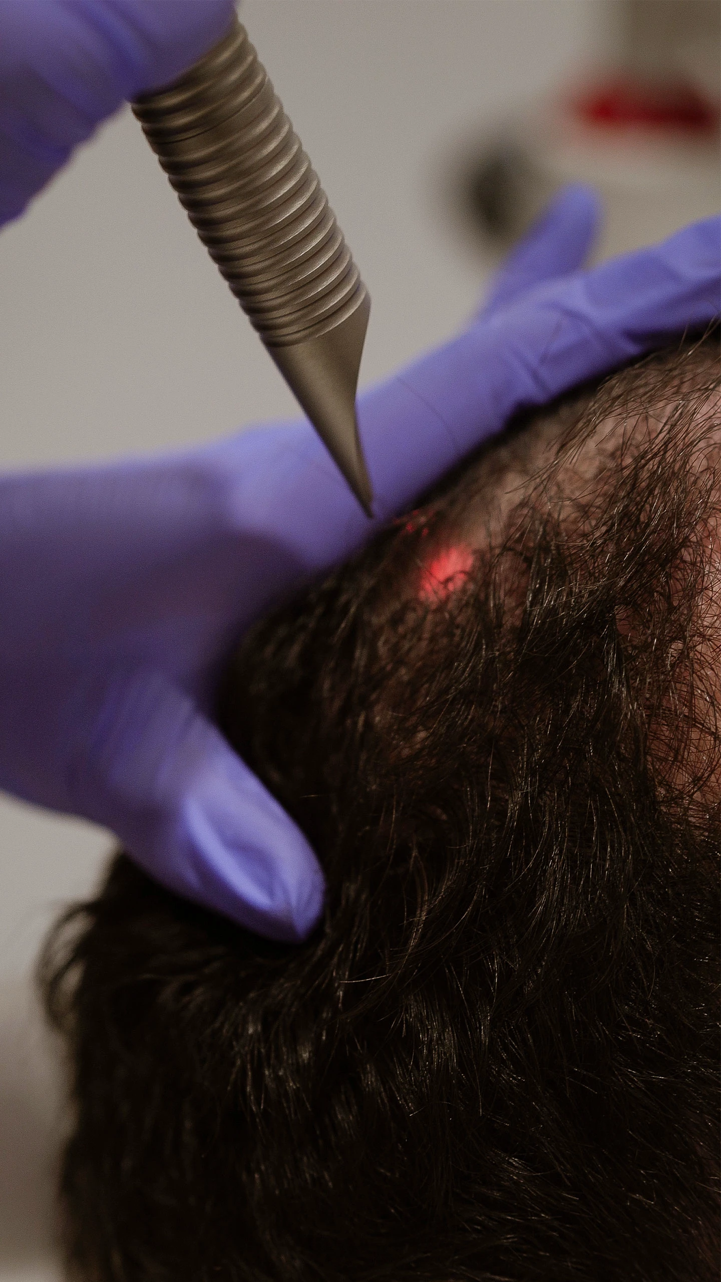 HAIRestart session at Clinique SkinIN with Fotona laser technology, targeting hair regrowth at the root.