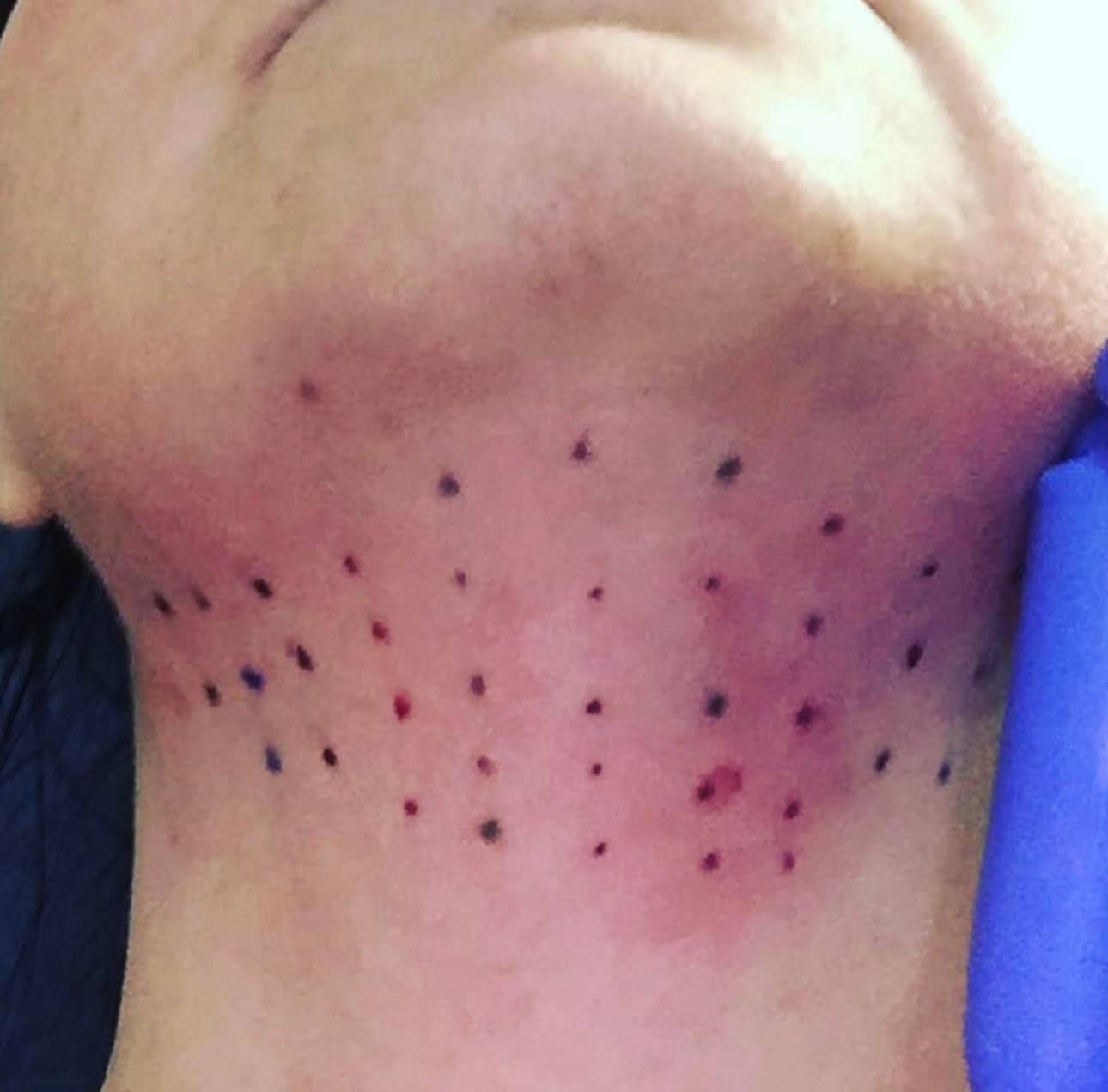 Un cou de femme avec le menton pleins de petits points de traçage