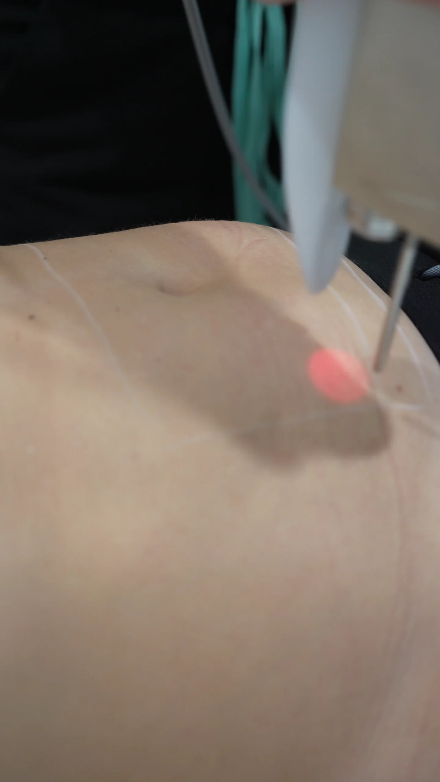 Laser treatment of the abdomen with targeted red light, used for body contouring.
